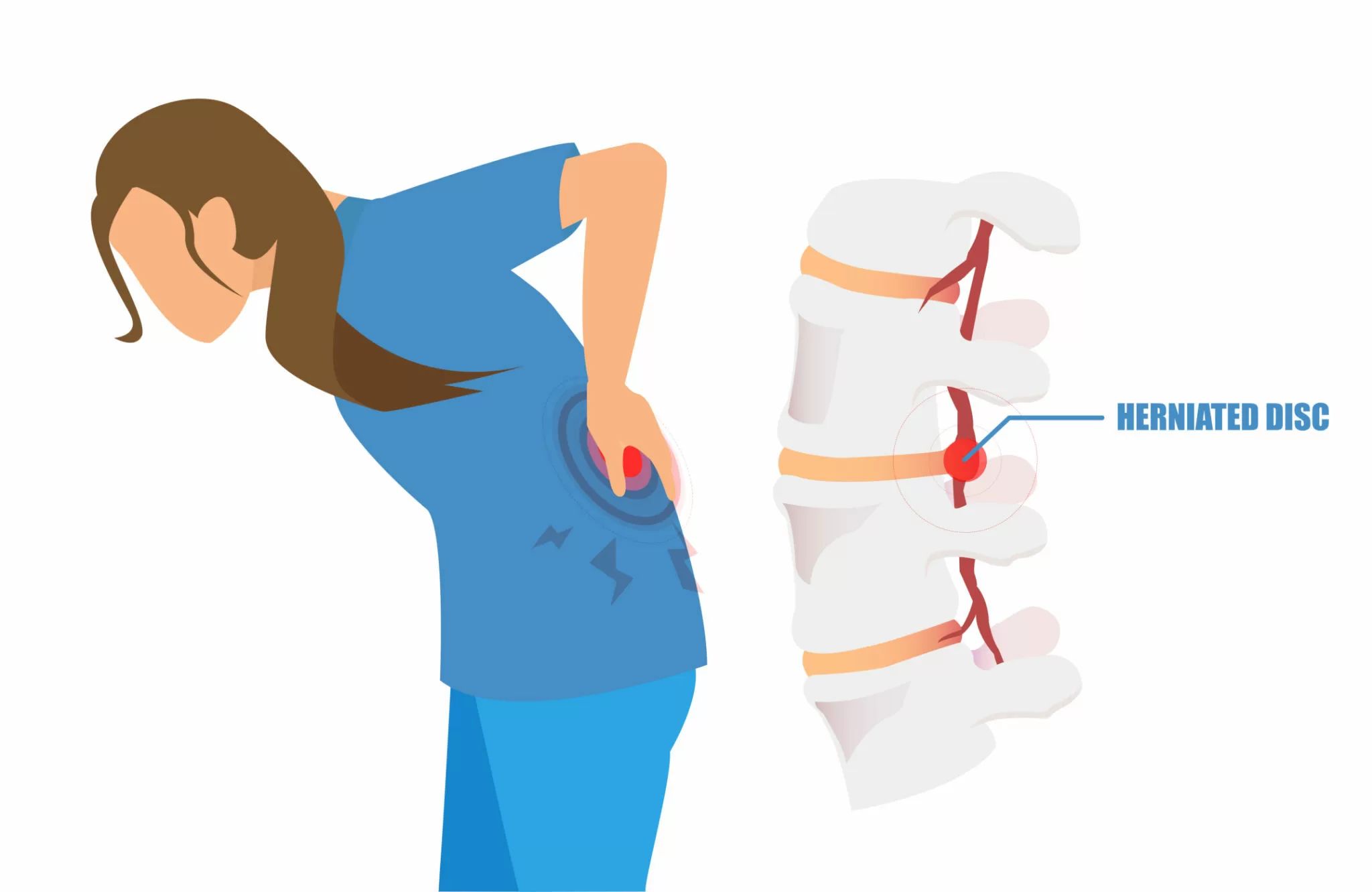 Sciatica Pain Treatment