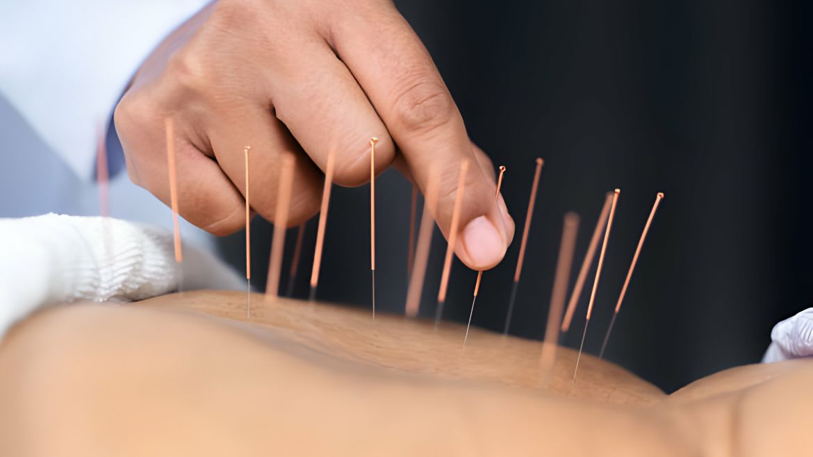 Dry Needling Treatment in Dubai