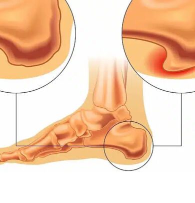 heel spur, or calcaneal spur