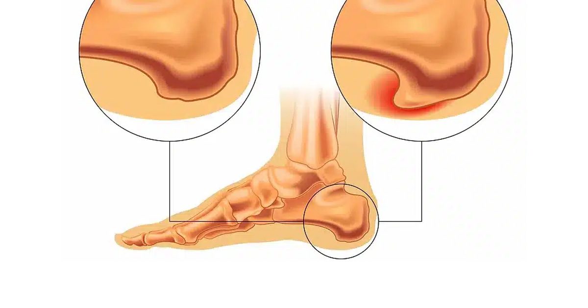 Understanding Heel Spurs Causes Symptoms And Diagnosis